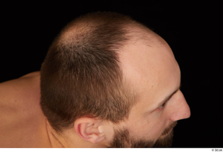 Orest bald hair 0007.jpg